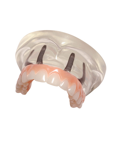 Dental implants