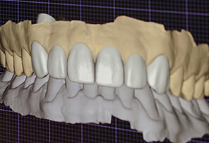 Dental Crowns and Bridges