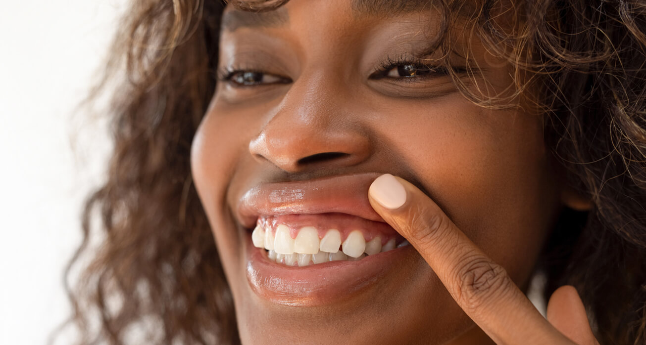 I Have a Gummy Smile, What Are My Options?