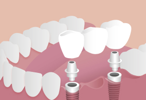 Implant-supported bridge