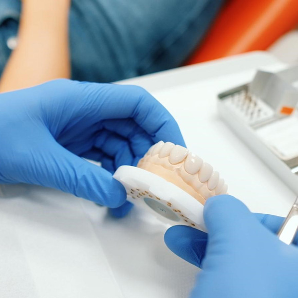 What are veneers?