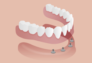 Mini-dental implants
