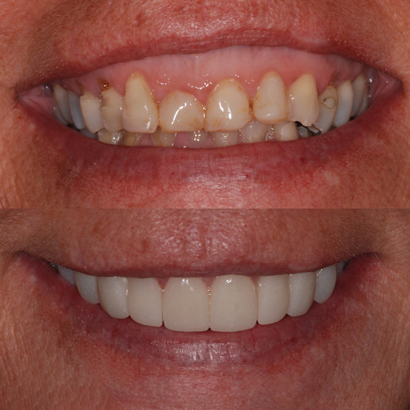 Gum contouring, Transform Your Smile in One Visit