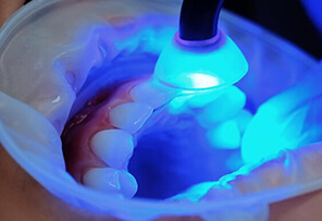 Composite Bonding
