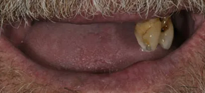 Before treatment at Queensway Dental
