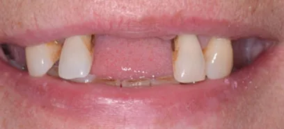Before treatment at Queensway Dental