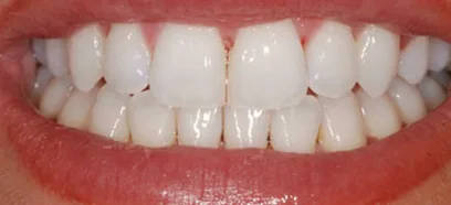 Before treatment at Queensway Dental