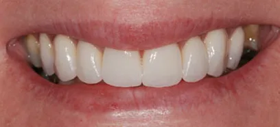 After treatment at Queensway Dental