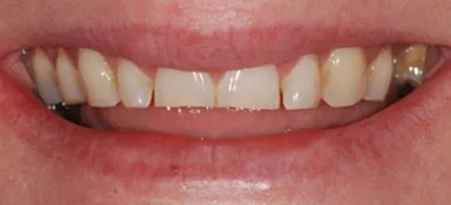 Before treatment at Queensway Dental