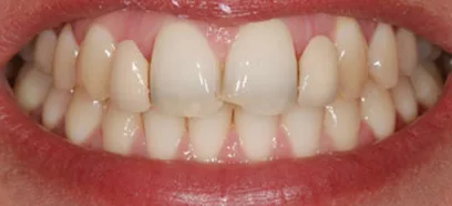 Before treatment at Queensway Dental