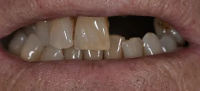 Before treatment at Queensway Dental