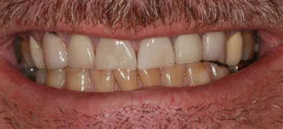 Before treatment at Queensway Dental