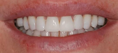 After treatment at Queensway Dental