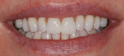 Before treatment at Queensway Dental