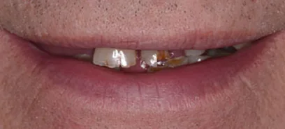 Before treatment at Queensway Dental