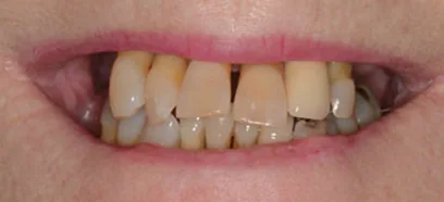 Before treatment at Queensway Dental