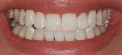 After treatment at Queensway Dental
