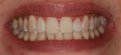 Before treatment at Queensway Dental