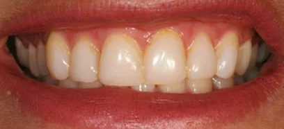 Before treatment at Queensway Dental