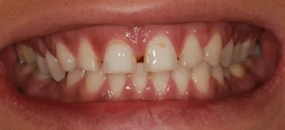 Before treatment at Queensway Dental