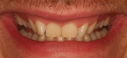 Before treatment at Queensway Dental