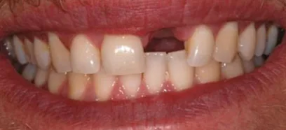 Before treatment at Queensway Dental