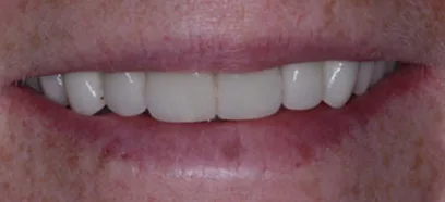 After treatment at Queensway Dental