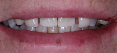Before treatment at Queensway Dental