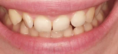 Before treatment at Queensway Dental