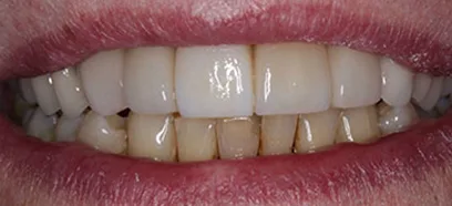 After treatment at Queensway Dental