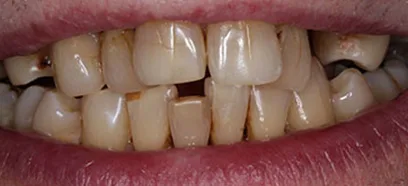 Before treatment at Queensway Dental