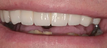 After treatment at Queensway Dental