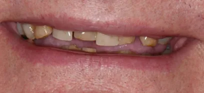 Before treatment at Queensway Dental