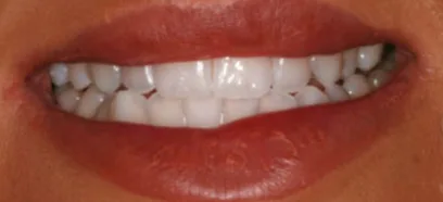 Before treatment at Queensway Dental