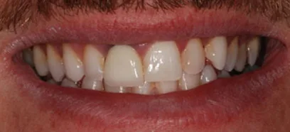 Before treatment at Queensway Dental