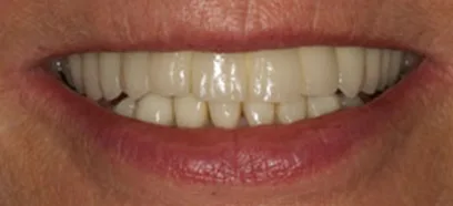 After treatment at Queensway Dental