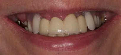 Before treatment at Queensway Dental