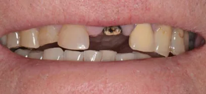 Before treatment at Queensway Dental