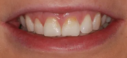 Before treatment at Queensway Dental