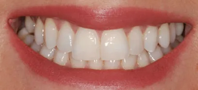 Before treatment at Queensway Dental