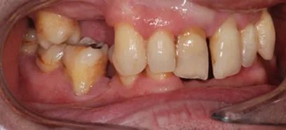 Before treatment at Queensway Dental