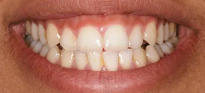 Before treatment at Queensway Dental