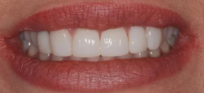After treatment at Queensway Dental