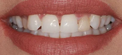 Before treatment at Queensway Dental