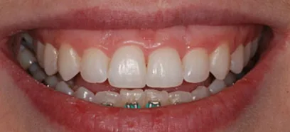 Before treatment at Queensway Dental