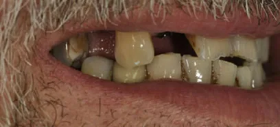 Before treatment at Queensway Dental