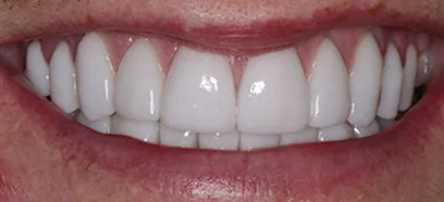 After treatment at Queensway Dental