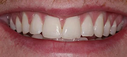 Before treatment at Queensway Dental