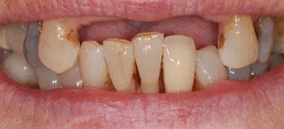 Before treatment at Queensway Dental
