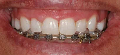 Before treatment at Queensway Dental